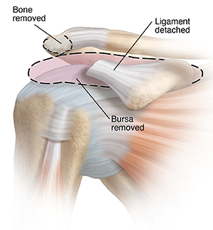 Front view of shoulder joint showing inflamed bursa and bone spur on acromion being removed.