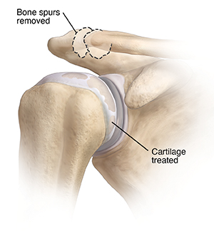 Front view of shoulder joint showing smoothed cartilage and bone spurs removed.