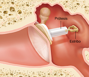 Corte transversal de un oído, donde pueden verse las estructuras del oído externo, interno y medio, con una prótesis que reemplaza el yunque.