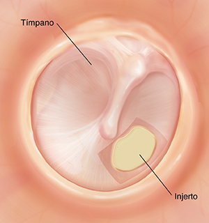 Tímpano reparado después de una perforación.