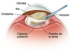 Corte transversal de vista frontal de un ojo donde puede verse un instrumento que quita el cristalino.