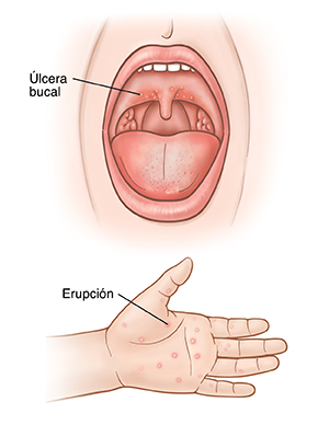 Boca abierta que muestra una llaga en la parte trasera del paladar. Primer plano de la palma de una mano que presenta un salpullido rojizo.