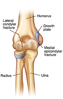 Vista frontal de la articulación del codo que muestra fractura del cóndilo lateral y fractura del epicóndilo medial.