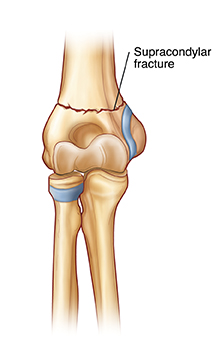 Vista frontal de la articulación del codo que muestra fractura supracondílea.